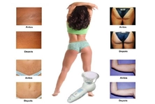 Selülit Giderici Kullanımı ve Faydaları Nelerdir?