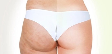 Kalçada Selülit Belirtileri ve Tedavisi