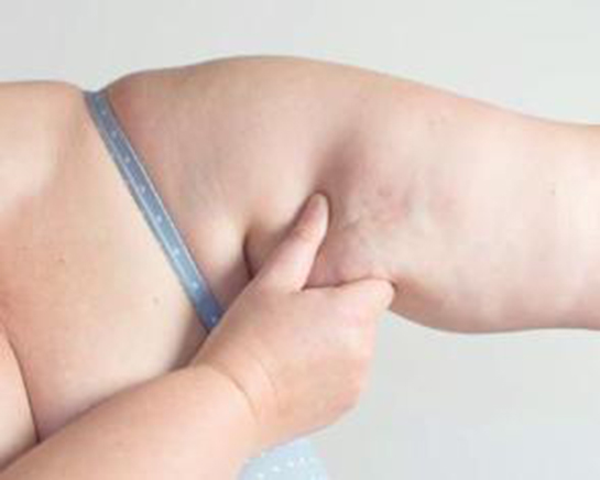 Kolda Selülit Belirtileri ve Tedavisi